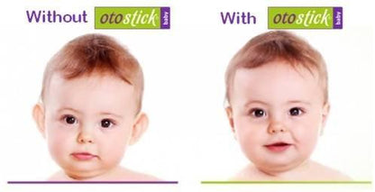 Otostick Corretor de Orelha Para Bebés Anne Claire Baby Store 